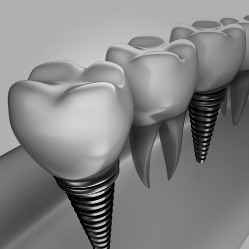implantes dentales en Roquetes Sant Pere de Ribes
