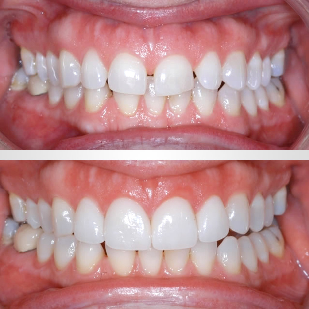 ortodoncia antes y después